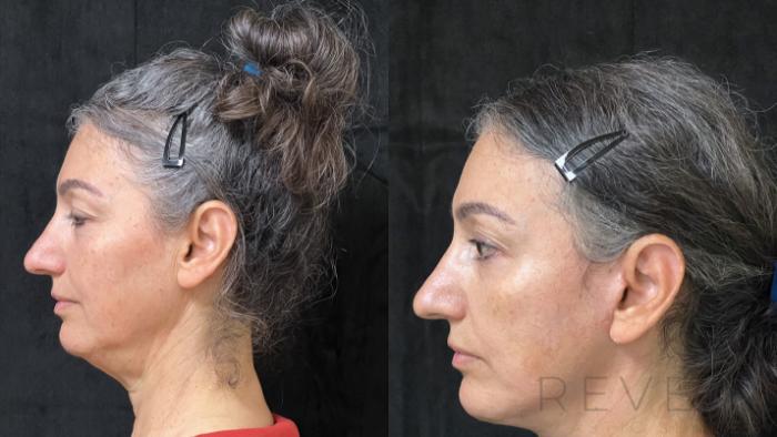 Before & After Neck Lift Case 676 Right Side View in San Jose, CA