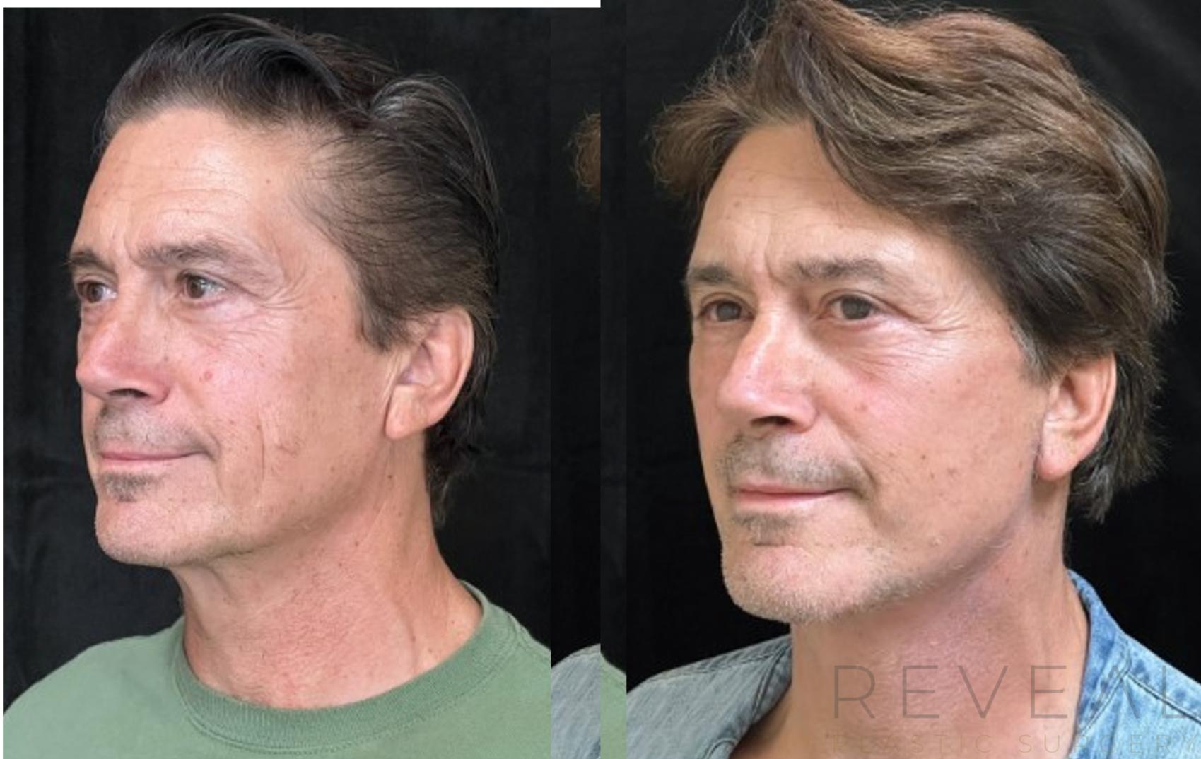 Before & After Facelift Case 703 Right Oblique View in San Jose, CA