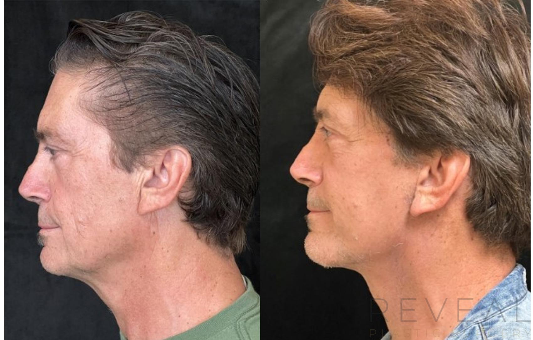 Before & After Facelift Case 703 Right Side View in San Jose, CA
