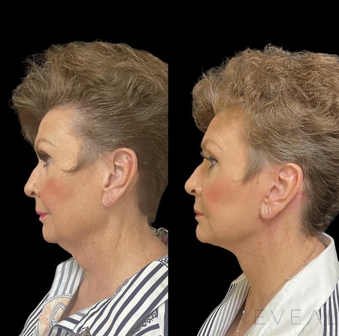 Before & After Facelift Case 714 Right Oblique View in San Jose, CA