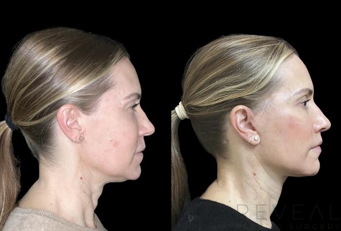 Before & After Neck Lift Case 747 Left Oblique View in San Jose, CA