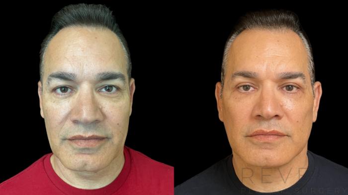 Before & After Facelift Case 764 Front View in San Jose, CA
