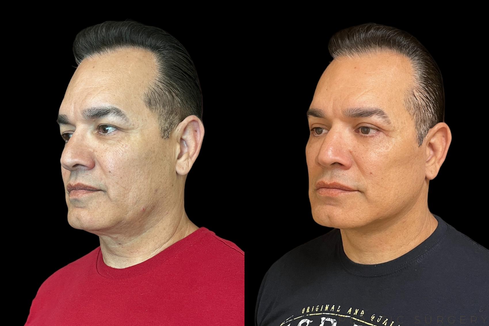 Before & After Facelift Case 764 Left Oblique View in San Jose, CA