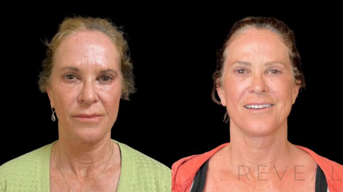 Before & After Eyelid Surgery Case 772 Front View in San Jose, CA