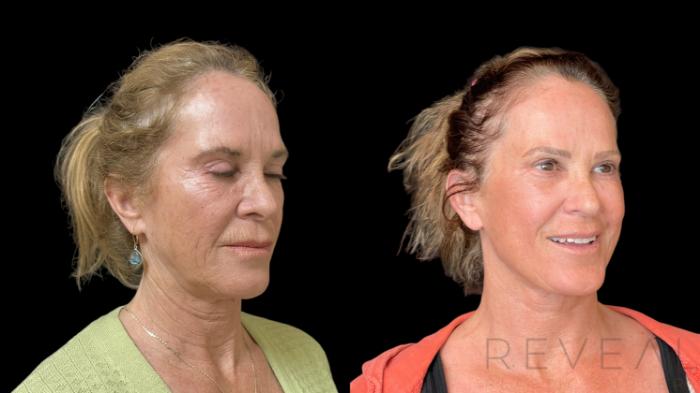 Before & After Neck Lift Case 772 Right Oblique View in San Jose, CA
