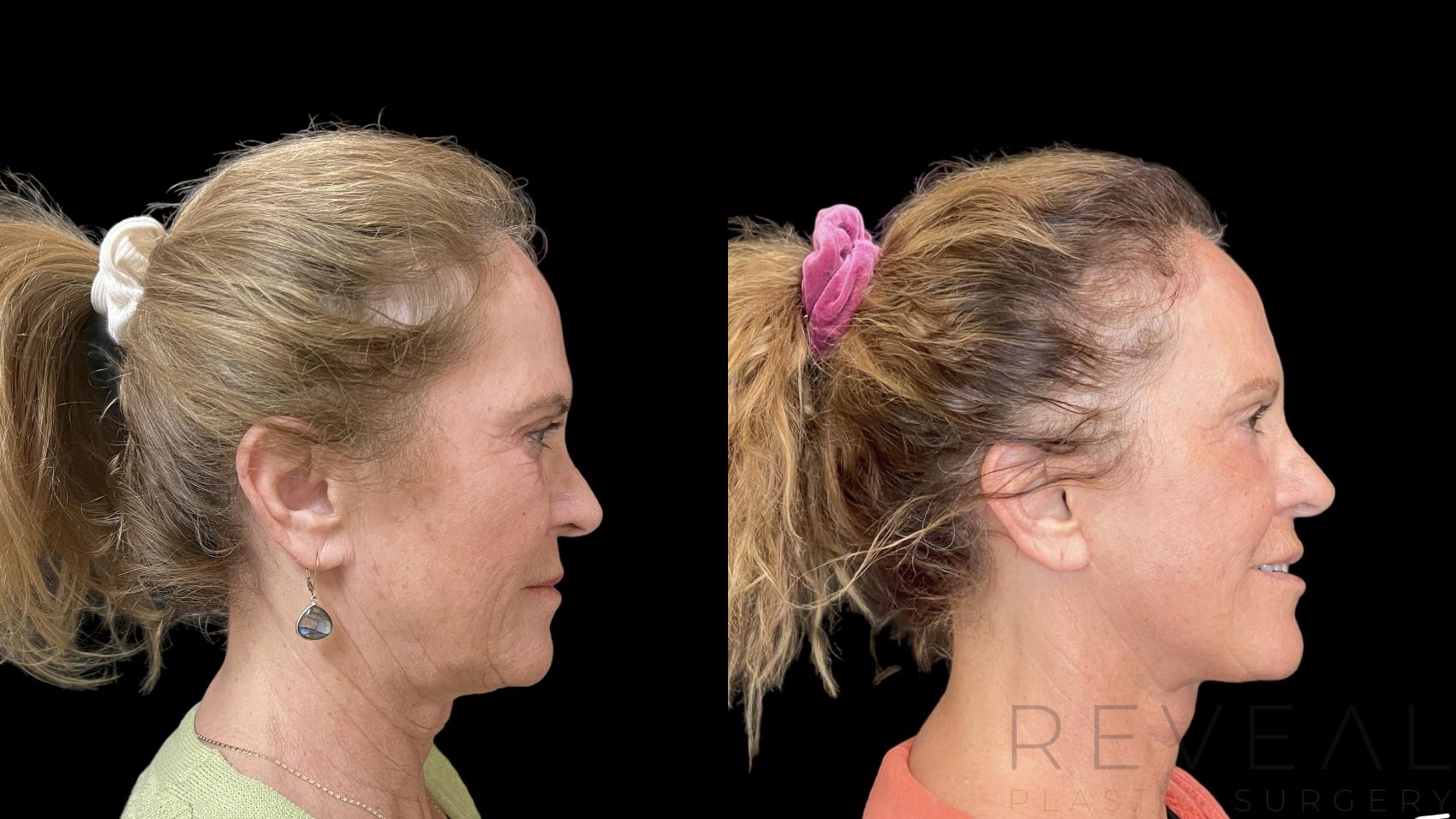 Before & After Facelift Case 772 Right Side View in San Jose, CA