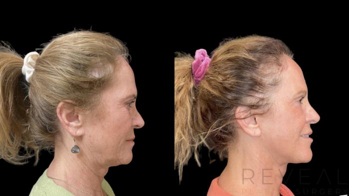 Before & After Neck Lift Case 772 Right Side View in San Jose, CA