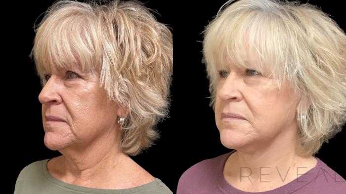 Before & After Facelift Case 782 Left Oblique View in San Jose, CA