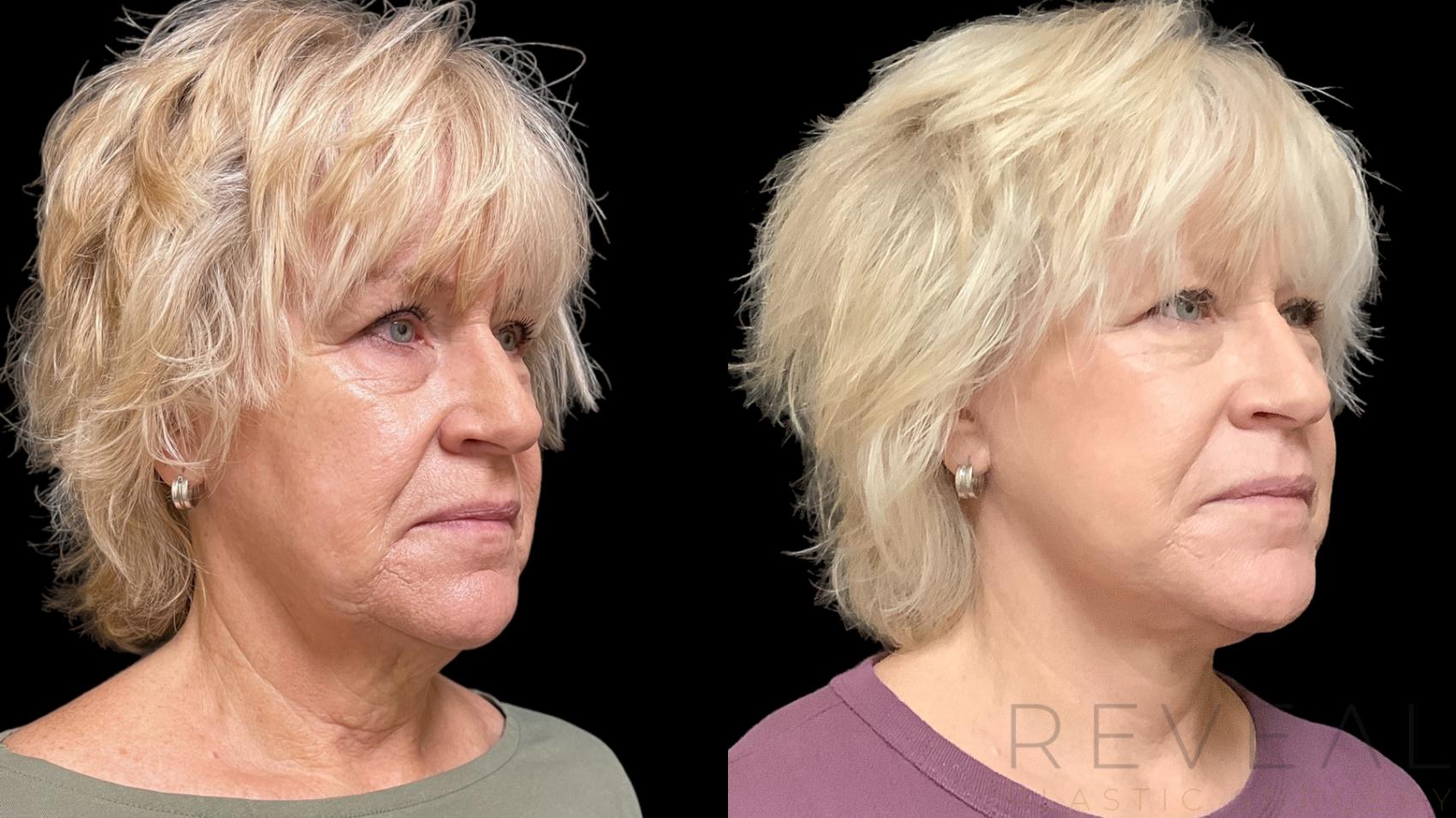 Before & After Facelift Case 782 Right Oblique View in San Jose, CA