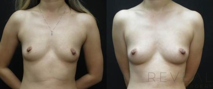Before & After Fat Transfer to Breasts Case 483 View #1 View in San Jose, CA