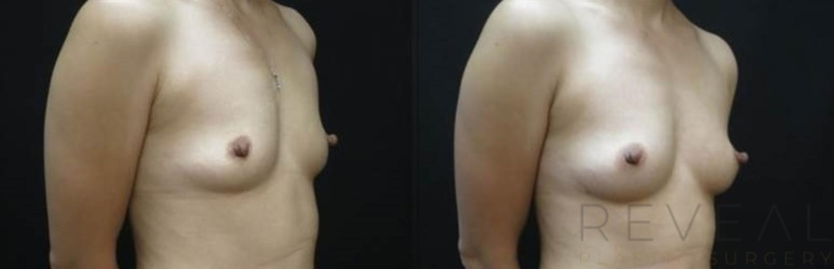 Before & After Fat Transfer to Breasts Case 483 View #2 View in San Jose, CA