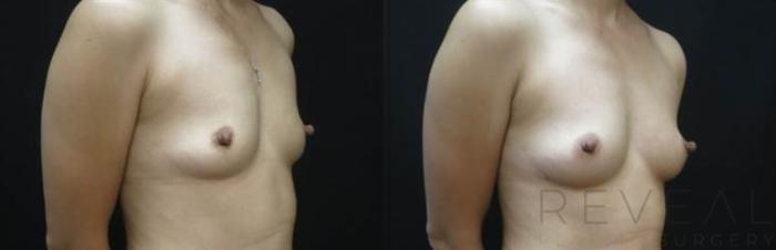 Before & After Fat Transfer to Breasts Case 483 View #2 View in San Jose, CA