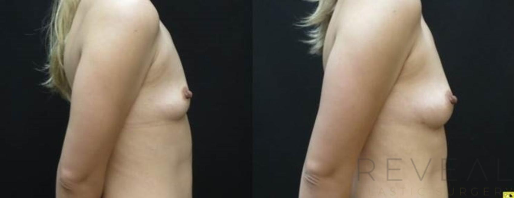 Before & After Fat Transfer to Breasts Case 483 View #3 View in San Jose, CA