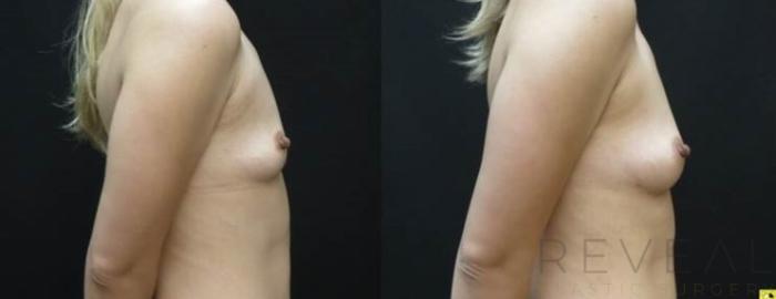 Before & After Fat Transfer to Breasts Case 483 View #3 View in San Jose, CA