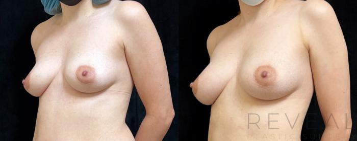 Before & After Fat Transfer to Breasts Case 724 Left Side View in San Jose, CA
