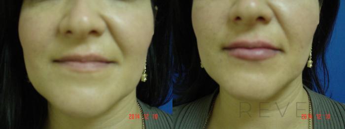Before & After Injectable Fillers Case 164 View #1 View in San Jose, CA