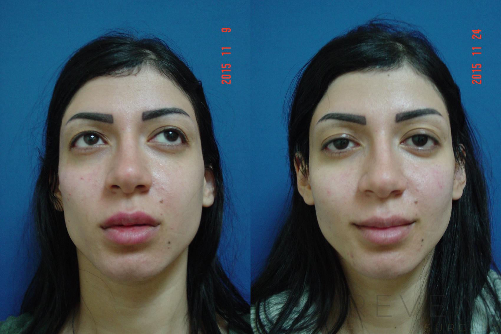 Before & After Injectable Fillers Case 184 View #1 View in San Jose, CA