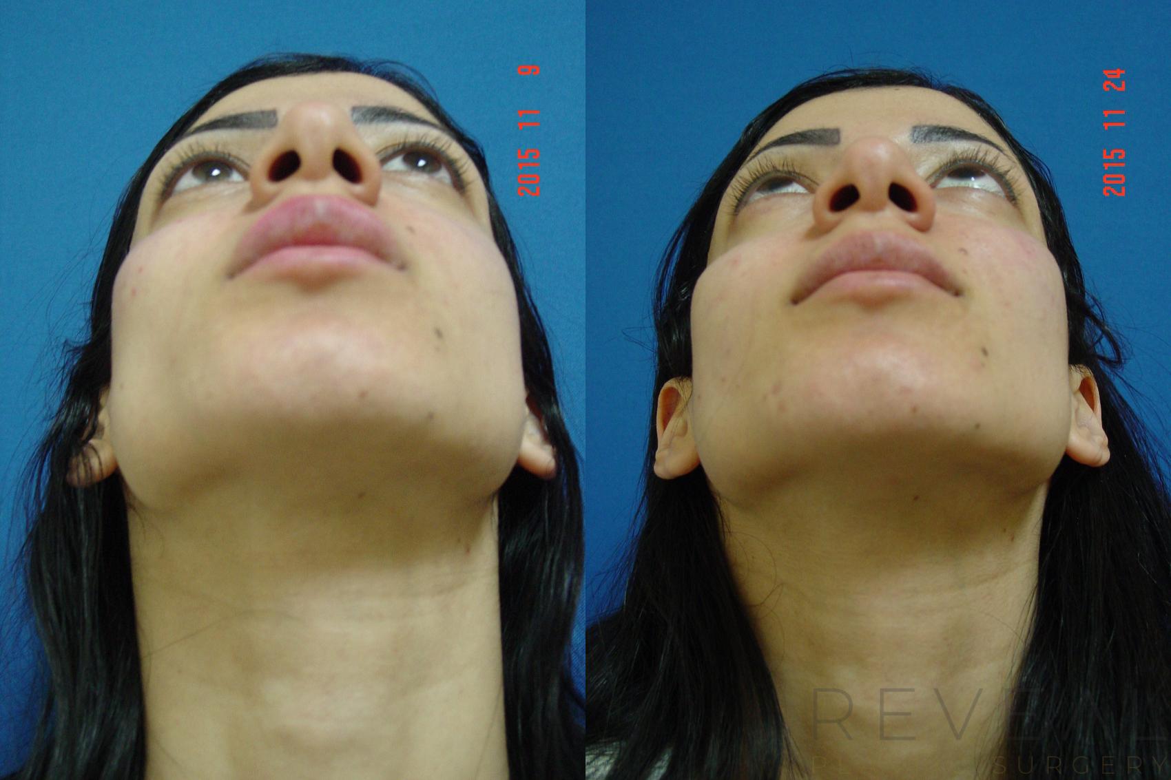 Before & After Injectable Fillers Case 184 View #2 View in San Jose, CA