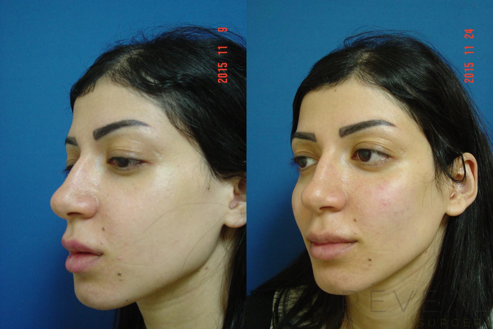 Before & After Injectable Fillers Case 184 View #3 View in San Jose, CA