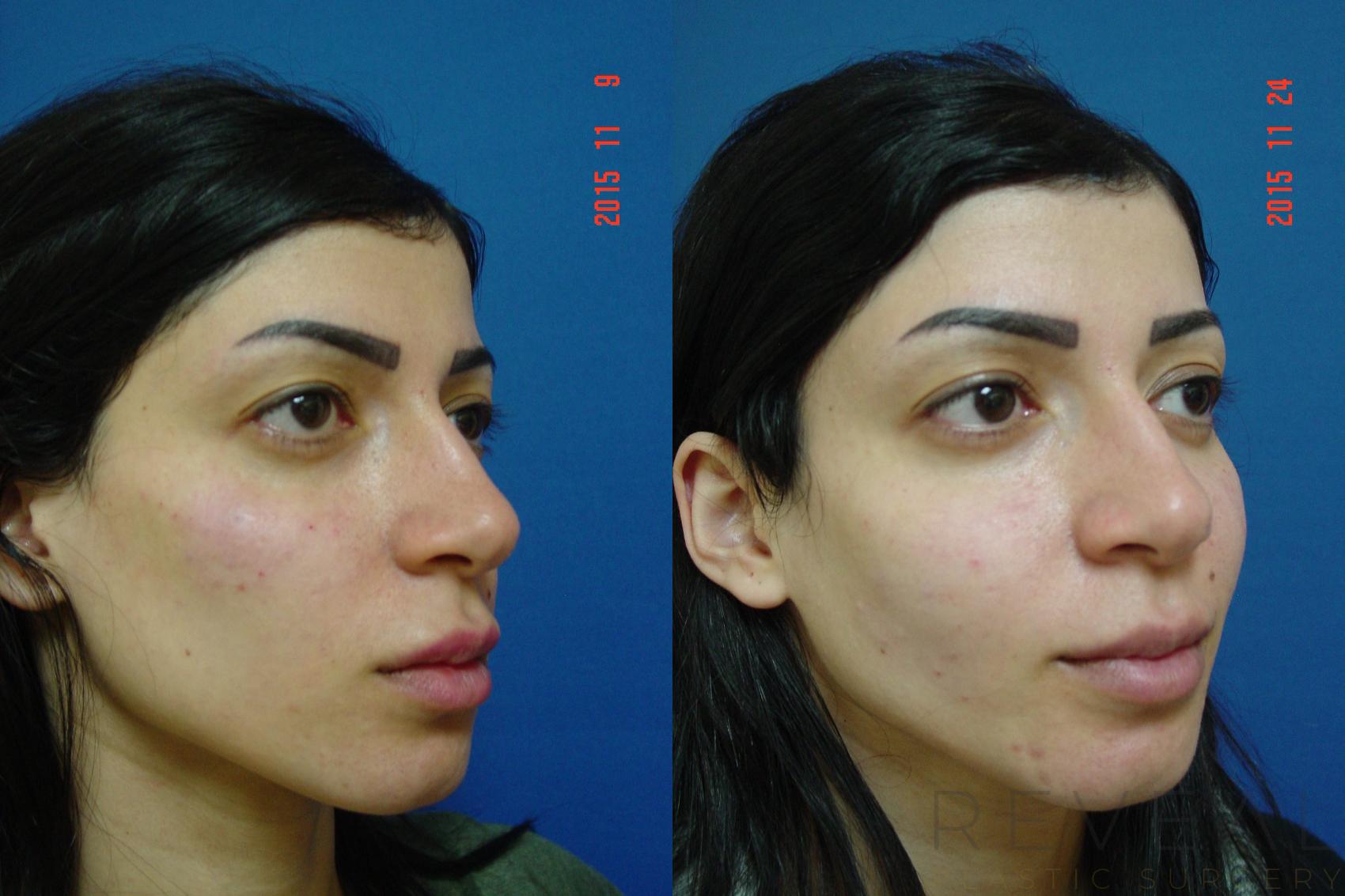 Before & After Injectable Fillers Case 184 View #4 View in San Jose, CA