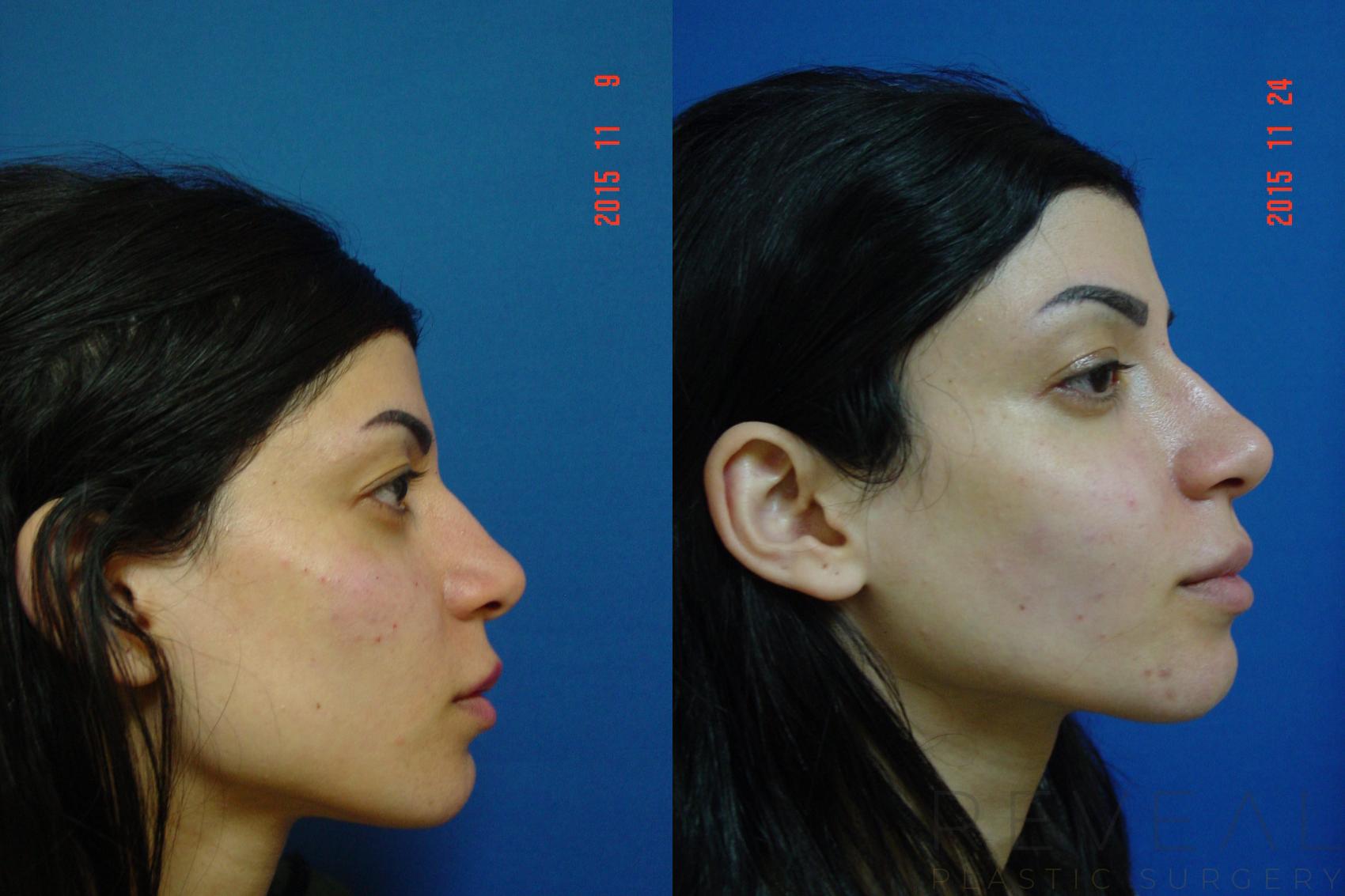 Before & After Injectable Fillers Case 184 View #5 View in San Jose, CA