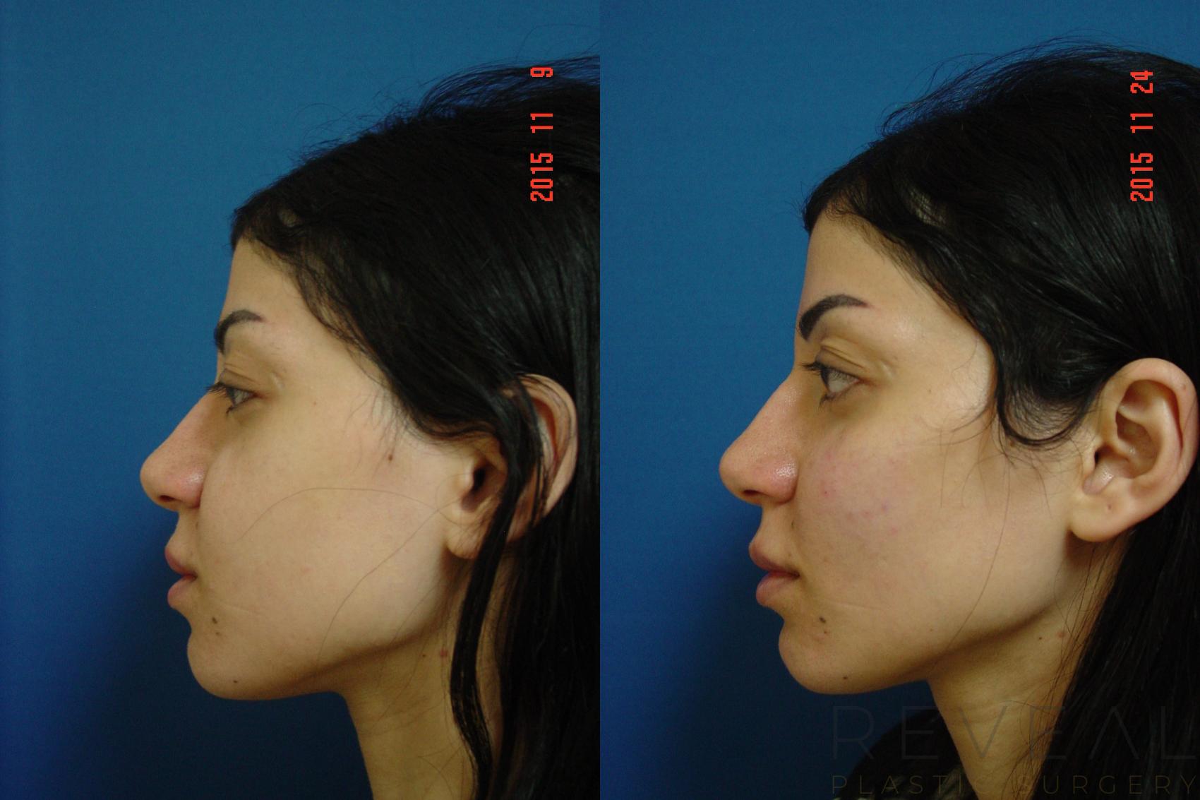 Before & After Injectable Fillers Case 184 View #6 View in San Jose, CA