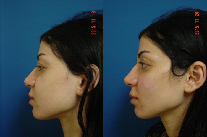 Before & After Injectable Fillers Case 184 View #6 View in San Jose, CA