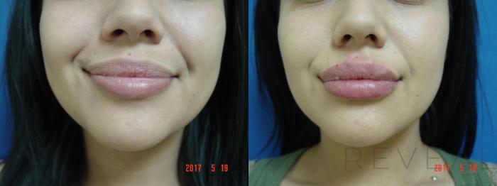Before & After Injectable Fillers Case 214 View #1 View in San Jose, CA