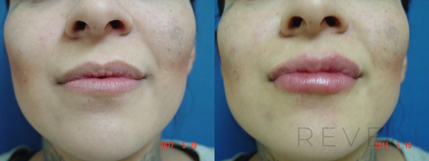 Before & After Injectable Fillers Case 215 View #1 View in San Jose, CA