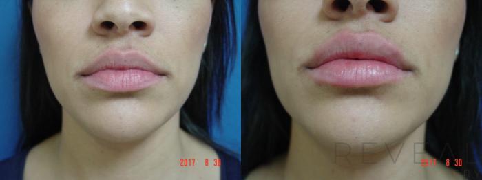 Before & After Injectable Fillers Case 220 View #1 View in San Jose, CA