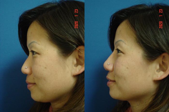 Before & After Injectable Fillers Case 387 View #1 View in San Jose, CA