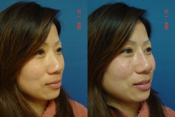 Before & After Injectable Fillers Case 387 View #2 View in San Jose, CA