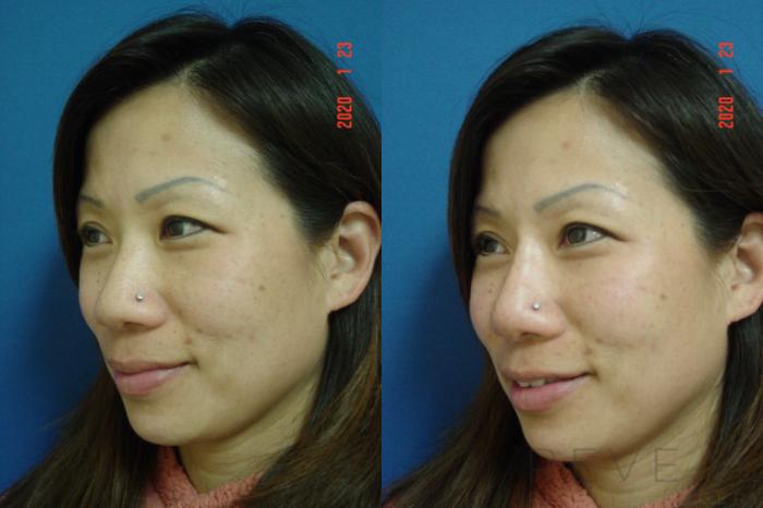 Before & After Injectable Fillers Case 387 View #5 View in San Jose, CA
