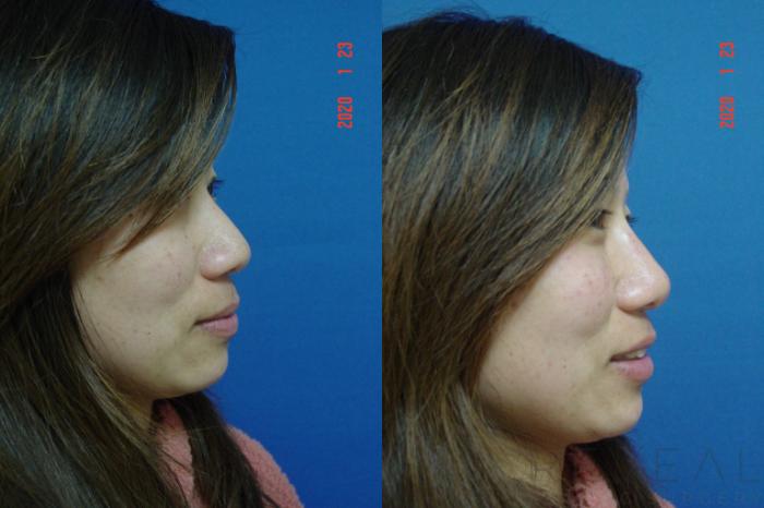 Before & After Injectable Fillers Case 387 View #6 View in San Jose, CA