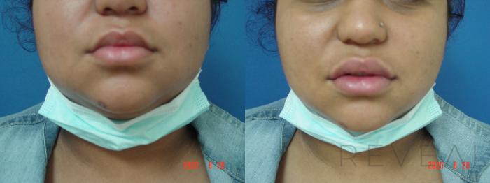 Before & After Injectable Fillers Case 416 View #1 View in San Jose, CA