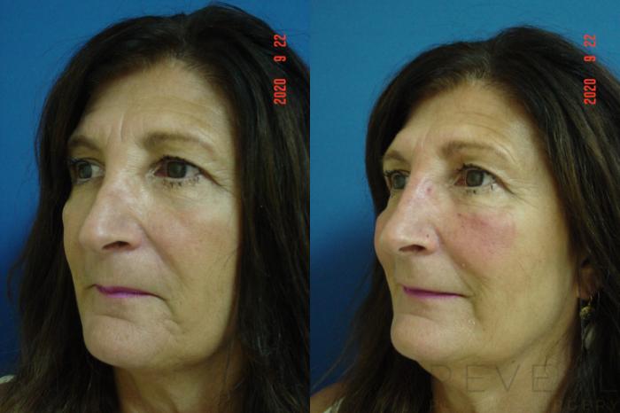 Before & After Injectable Fillers Case 426 View #1 View in San Jose, CA