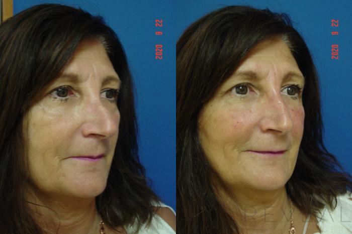 Before & After Injectable Fillers Case 426 View #2 View in San Jose, CA