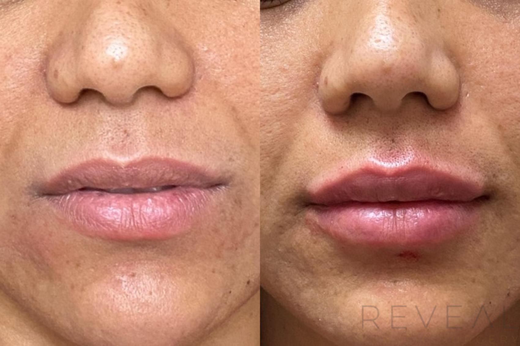 Before & After Injectable Fillers Case 446 View #1 View in San Jose, CA