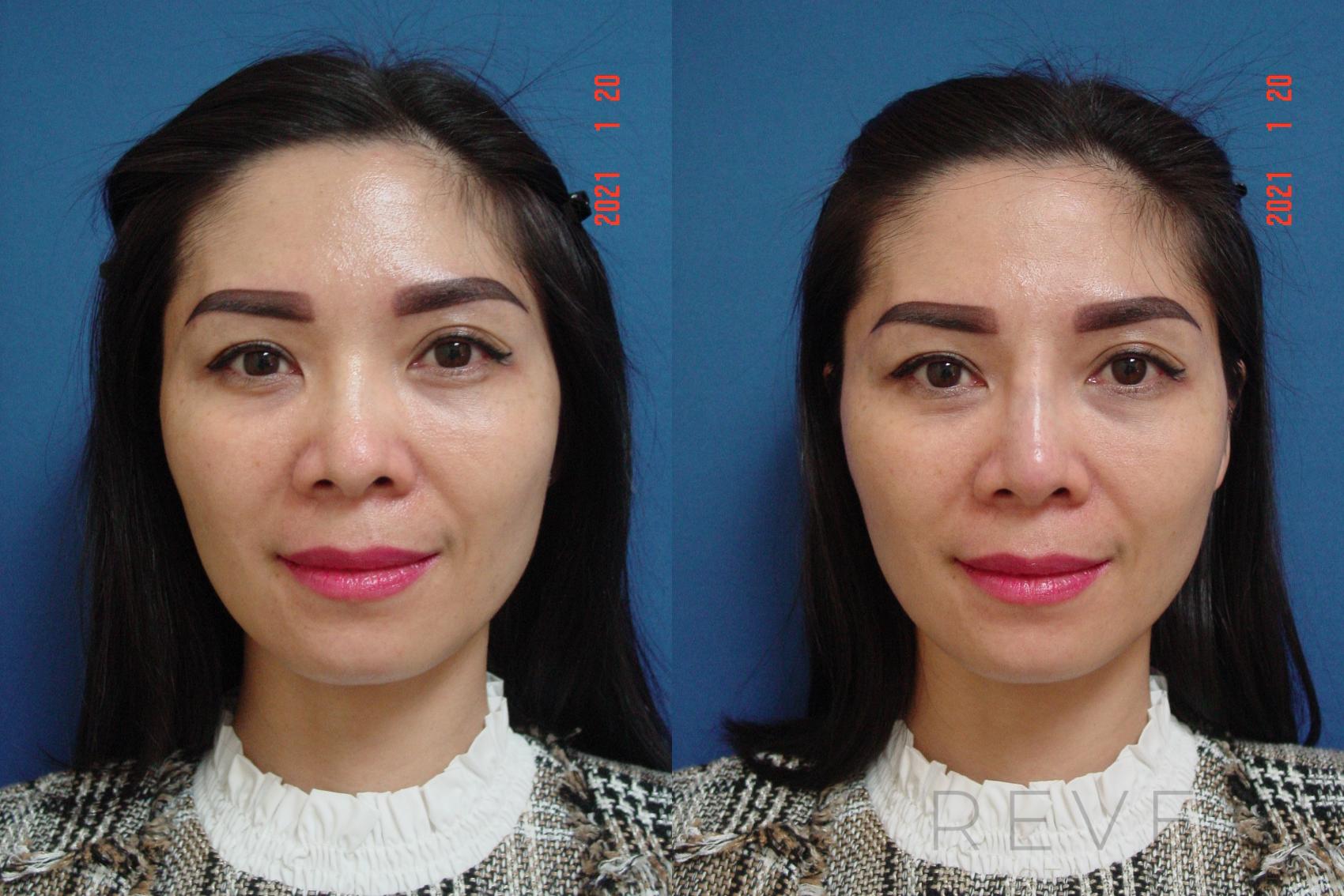 Before & After Injectable Fillers Case 524 View #1 View in San Jose, CA