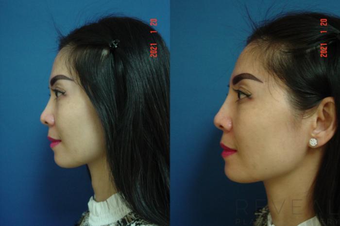Before & After Injectable Fillers Case 524 View #2 View in San Jose, CA