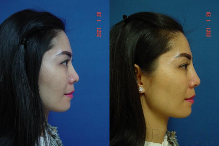 Before & After Injectable Fillers Case 524 View #3 View in San Jose, CA