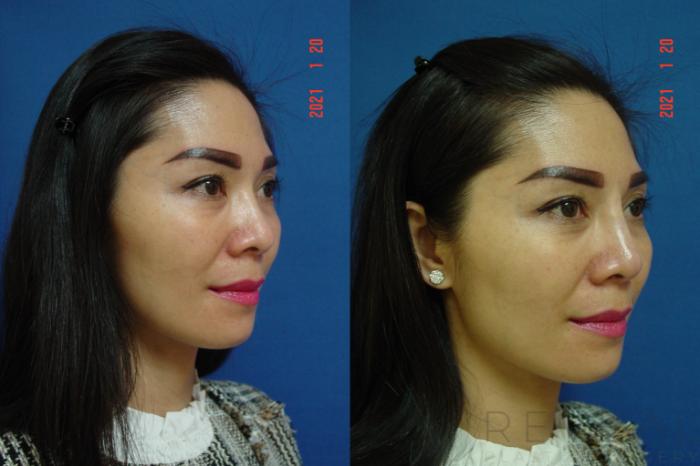 Before & After Injectable Fillers Case 524 View #4 View in San Jose, CA