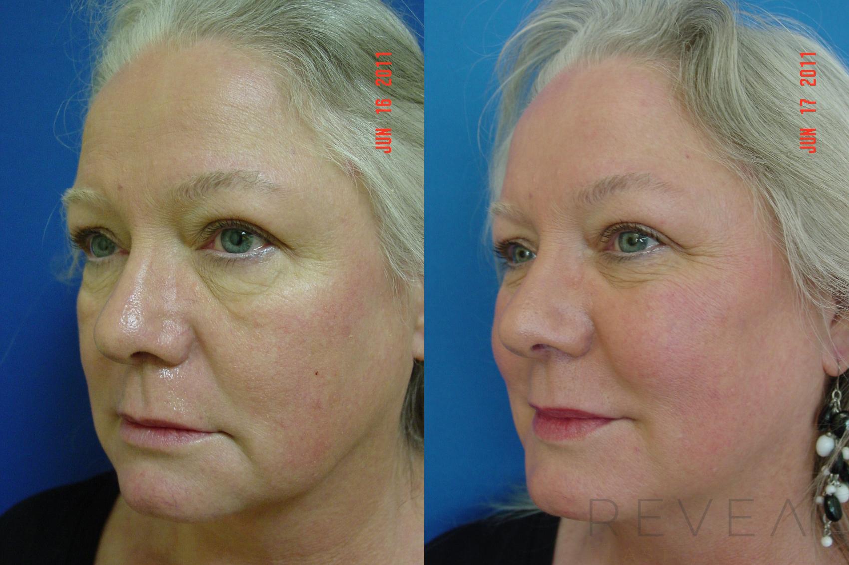 Before & After Injectable Fillers Case 71 View #1 View in San Jose, CA
