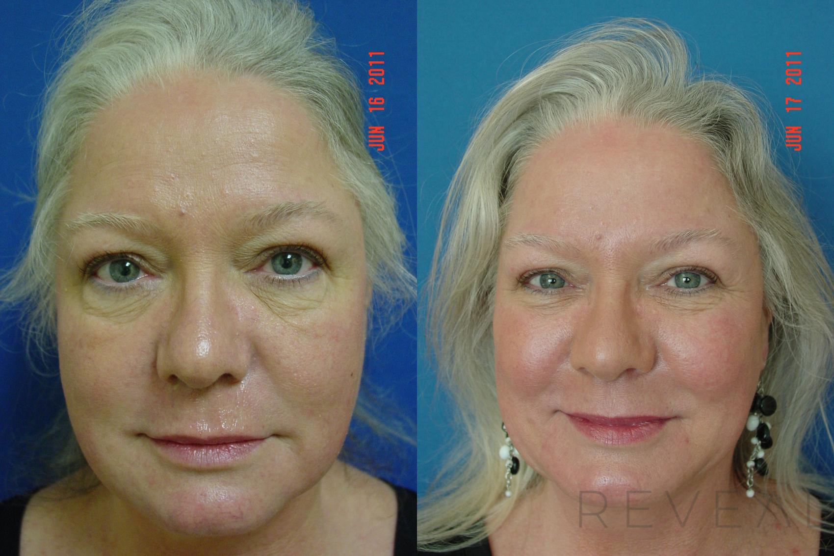 Before & After Injectable Fillers Case 71 View #2 View in San Jose, CA