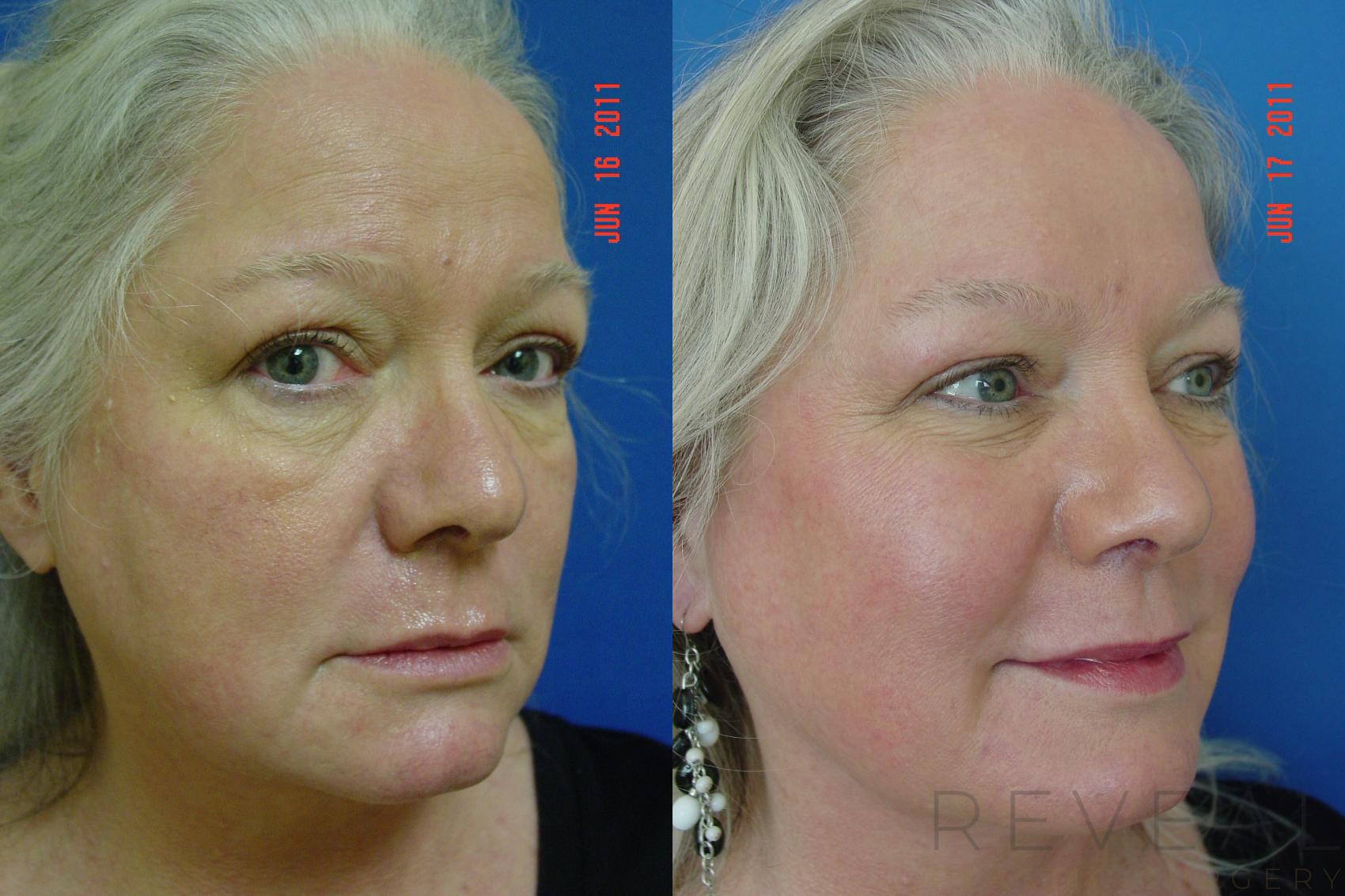Before & After Injectable Fillers Case 71 View #3 View in San Jose, CA