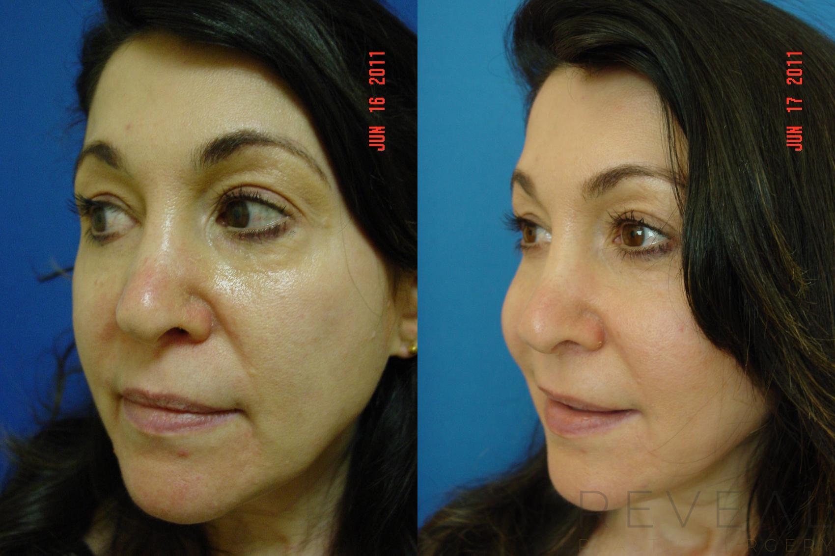 Before & After Injectable Fillers Case 72 View #1 View in San Jose, CA