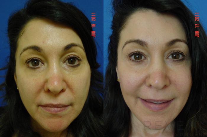 Before & After Injectable Fillers Case 72 View #2 View in San Jose, CA