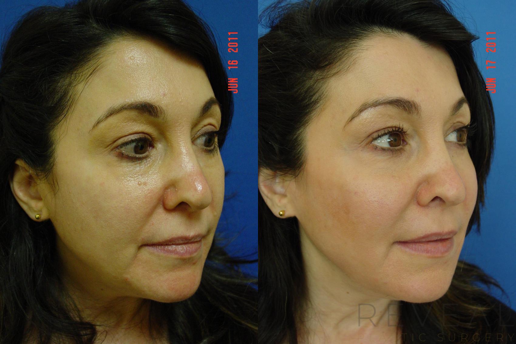 Before & After Injectable Fillers Case 72 View #3 View in San Jose, CA