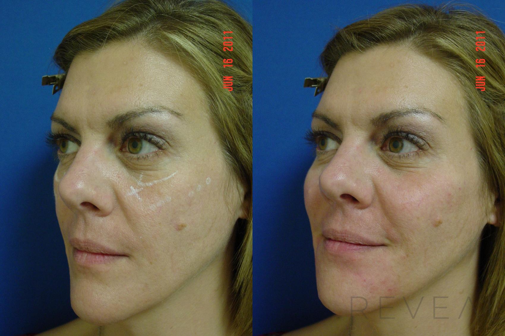 Before & After Injectable Fillers Case 73 View #1 View in San Jose, CA