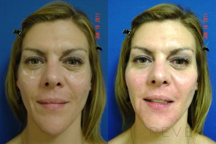 Before & After Injectable Fillers Case 73 View #2 View in San Jose, CA